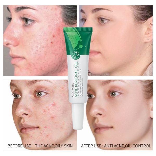 ⁦Aloe Acne Treatment Gel Face Cream Serum Anti Acne Scar Cream Shrink Pores Moisturizing Oil Control Soothing Skin Care⁩ - الصورة ⁦2⁩