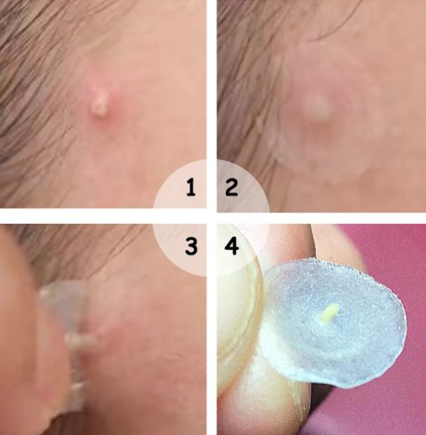 ⁦Acne stickers, night acne stickers, fade acne marks⁩ - الصورة ⁦2⁩