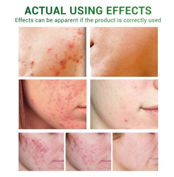 ⁦Acne Treatment Serum Facial Repair Oil⁩ - الصورة ⁦7⁩
