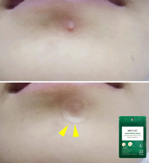 ⁦Acne stickers, night acne stickers, fade acne marks⁩ - الصورة ⁦3⁩